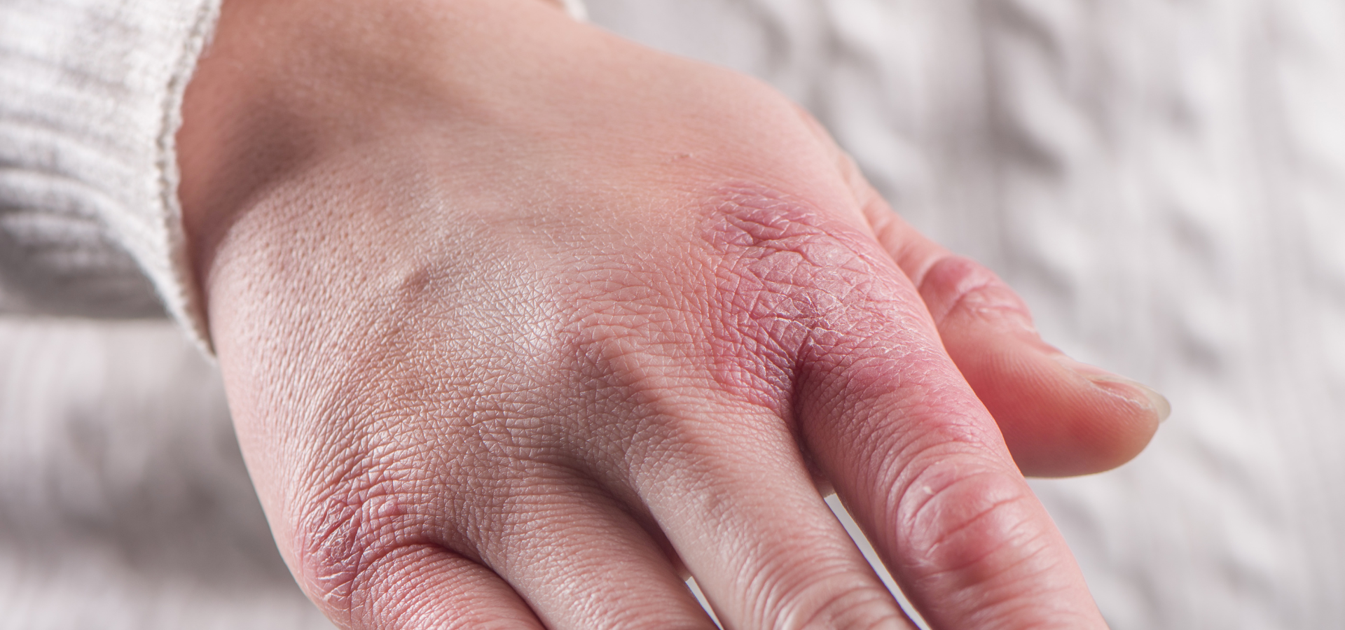 Histaminová intolerance